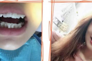 湖州陳景康牙科診所甘喜文整形價(jià)格表附牙齒陶瓷矯正案例展示