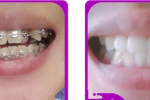 湖州陳景康牙科診所邰曉燕整形價(jià)格表附金屬托槽矯正案例展示