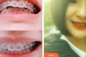 湖州陳景康牙科診所陳飛燕整形價(jià)格表附金屬托槽矯正案例展示