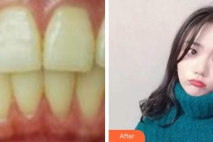 湖州鼎植口腔醫(yī)院杜文華整形價(jià)格表附冷光美白案例展示