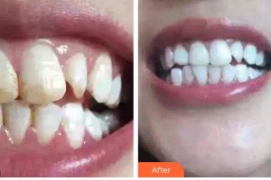 湖州鼎植口腔醫(yī)院李鳴元整形價(jià)格表附冷光美白案例展示