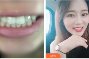 湖州徐兆桂牙科診所徐強(qiáng)整形價(jià)格表附金屬托槽矯正案例展示