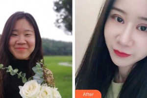 湖州市中心醫(yī)院眼科周紅整形價(jià)格表附眼部綜合案例展示