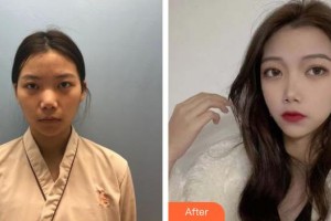 湖州市中心醫(yī)院眼科陳建康整形價(jià)格表附眼部綜合案例展示