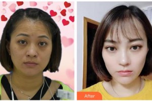 湖州市中心醫(yī)院眼科張軍輝整形價(jià)格表附激光去眼袋案例展示