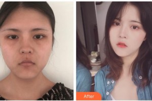 紹興華美整形美容醫(yī)院葉品英整形價(jià)格表附埋線提升案例展示