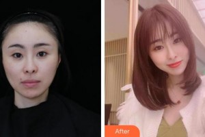 紹興華美整形美容醫(yī)院謝劍整形價格表附膠原蛋白除皺案例展示