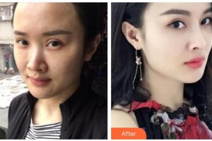 紹興華美整形美容醫(yī)院楊麗整形價格表附熱瑪吉案例展示