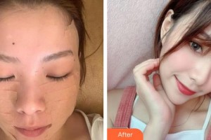 紹興市婦幼保健院醫(yī)療美容科俞國寶整形價格表附埋線提升案例展示