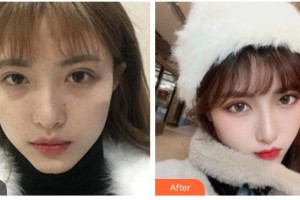 紹興施美爾整形美容醫(yī)院張科整形價格表附熱瑪吉案例展示