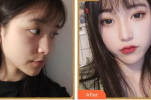 紹興華美整形美容醫(yī)院王伊萍整形價格表附埋線提升案例展示