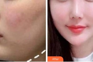 紹興華美整形美容醫(yī)院鄭志峰整形價格表附膠原蛋白除皺案例展示