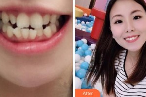 紹興市人民醫(yī)院醫(yī)療美容科王海花整形價格表附金屬托槽矯正案例展示