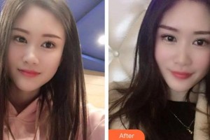 紹興市人民醫(yī)院醫(yī)療美容科阮土耿整形價格表附冷光美白案例展示