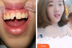 紹興越中口腔醫(yī)院高月忠整形價格表附美白貼片案例展示