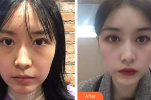 深圳美度醫(yī)療美容醫(yī)院劉玲住院醫(yī)師整形價格表附眼修復(fù)案例展示