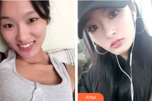 深圳賀五洲醫(yī)療美容診所胡開賢整形價格表附鼻部手術(shù)案例展示