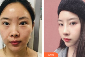 深圳美芮（原雅唯）醫(yī)療美容門診部夏超整形價格表附鼻部手術(shù)案例展示