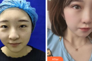 深圳美芮（原雅唯）醫(yī)療美容門診部曹琛整形價格表附雙眼皮案例展示