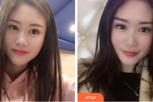 紹興越城口腔醫(yī)院孟海鋒整形價格表附冷光美白案例展示