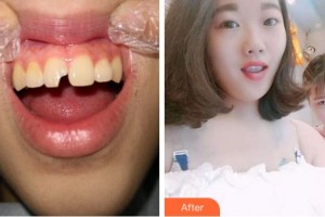 紹興越城口腔醫(yī)院王偉整形價格表附美白貼片案例展示