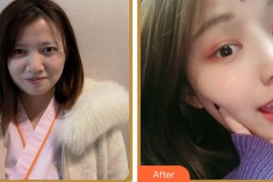 紹興愛(ài)爾眼科醫(yī)院周玲芬整形價(jià)格表附眼部綜合案例展示