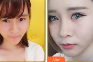 紹興愛(ài)爾眼科醫(yī)院王勝利整形價(jià)格表附眼部綜合案例展示