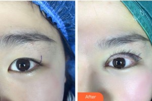 紹興愛(ài)爾眼科醫(yī)院郭雪琴整形價(jià)格表附眼部綜合案例展示