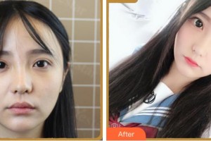 紹興愛(ài)爾眼科醫(yī)院王記紅整形價(jià)格表附眼部綜合案例展示