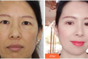 紹興愛(ài)爾眼科醫(yī)院史皞整形價(jià)格表附切開(kāi)雙眼皮案例展示