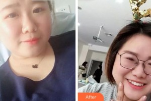 紹興市口腔醫(yī)院羅善峰整形價(jià)格表附牙齒隱形矯正案例展示