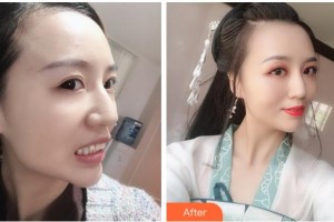 紹興市口腔醫(yī)院葉秋萍整形價(jià)格表附牙齒隱形矯正案例展示