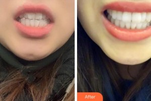 紹興京韓口腔醫(yī)院全熙鎮(zhèn)整形價(jià)格表附隱形托槽矯正案例展示