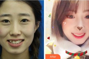 紹興京韓口腔醫(yī)院金力峰整形價(jià)格表附金屬托槽矯正案例展示