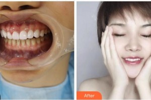 紹興京韓口腔醫(yī)院李運(yùn)科整形價(jià)格表附美白貼片案例展示