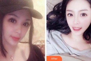 紹興德維口腔醫(yī)院潘昕整形價(jià)格表附牙齒隱形矯正案例展示