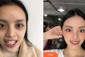 紹興柯橋口腔醫(yī)院張祥鋒整形價(jià)格表附隱形托槽矯正案例展示