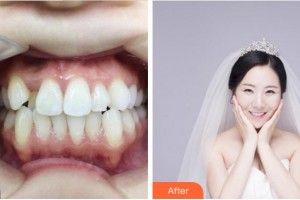 紹興柯橋口腔醫(yī)院郭曉燕整形價(jià)格表附金屬托槽矯正案例展示