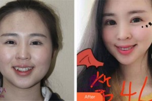 紹興柯橋口腔醫(yī)院楊學(xué)鵬整形價(jià)格表附金屬托槽矯正案例展示