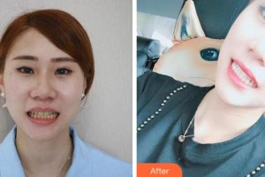 紹興博雅口腔醫(yī)院何淼鑫整形價(jià)格表附美白劑美白牙齒案例展示