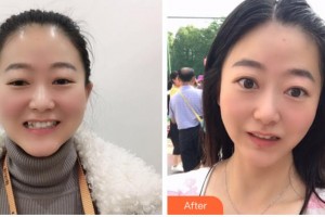 紹興博雅口腔醫(yī)院朱騰飛整形價(jià)格表附牙齒隱形矯正案例展示