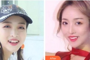 紹興博雅口腔醫(yī)院黃海波整形價(jià)格表附隱形托槽矯正案例展示