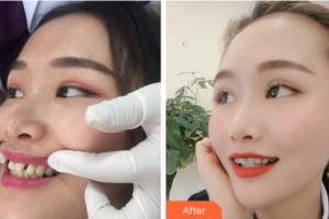 紹興博雅口腔醫(yī)院侯依桐整形價(jià)格表附隱形托槽矯正案例展示