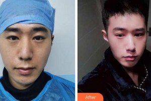 紹興袍江醫(yī)院眼科李厚碩整形價(jià)格表附眼部綜合案例展示