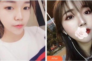 紹興袍江醫(yī)院眼科屠清安整形價(jià)格表附切開雙眼皮案例展示