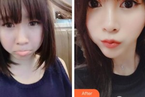 紹興袍江醫(yī)院眼科王湘娟整形價(jià)格表附眼部綜合案例展示