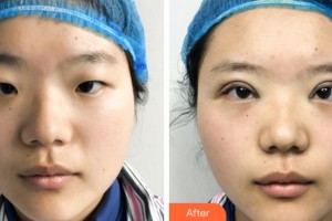 紹興袍江醫(yī)院眼科李田整形價(jià)格表附眼部綜合案例展示