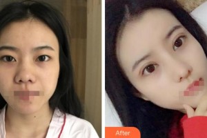 紹興市柯橋區(qū)中醫(yī)醫(yī)院眼科李偉整形價(jià)格表附切開雙眼皮案例展示