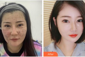 金華芘麗芙（原華美）整形醫(yī)院史頌民整形價(jià)格表附熱瑪吉案例展示