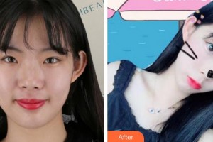 江蘇省蘇北人民醫(yī)院整形美容中心黃金華整形價(jià)格表附熱瑪吉案例展示